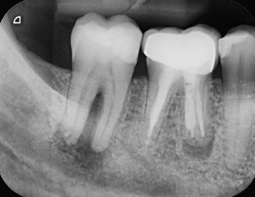 X-ray Of Two Human Tooth Molars