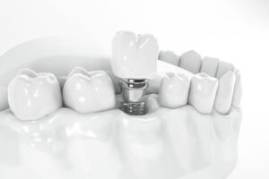 Tooth Implants in San Antonio Texas