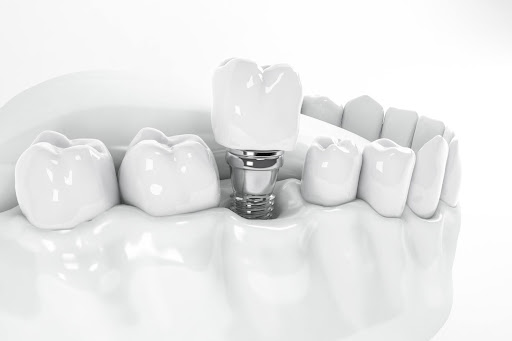 Tooth Implants in San Antonio Texas