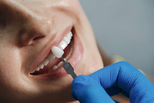 Ultimate Guide to Full Tooth Implants