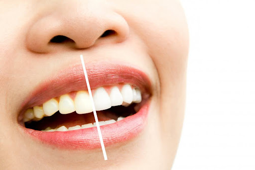 Teeth Whitening vs Bleaching