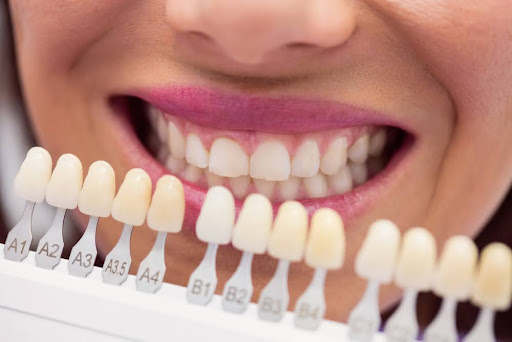 Teeth Whitening vs. Teeth Bleaching
