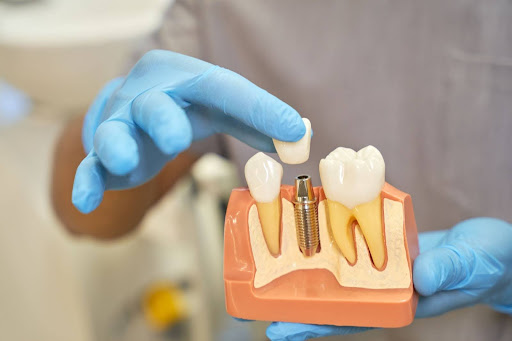 Prevent Dental Implant Failure