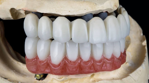 Dental Bridges for Front Teeth