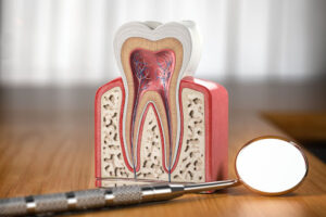 Root Canal Infection