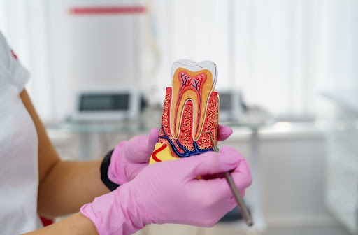 Root Canal Therapy vs. Tooth Extraction